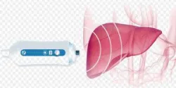 Kết quả đo mức gan nhiễm mỡ sau siêu âm đánh giá xơ hóa gan (Fibrosis)