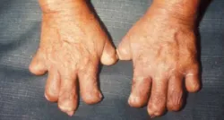 Những đại dịch bệnh lớn trên thế giới