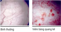 Viêm bàng quang kẽ: Những điều cần biết