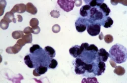 Xét nghiệm tế bào Hargraves (tế bào LE) trong chẩn đoán bệnh lupus ban đỏ hệ thống