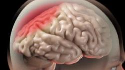 Phẫu thuật u thân não bằng đường mở nắp sọ