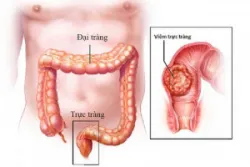 Viêm trực tràng điều trị thế nào?