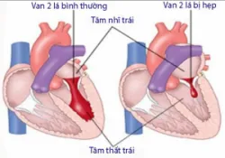 Cung lượng tim là gì?