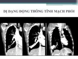 Bệnh phổi bẩm sinh: Những điều cần biết