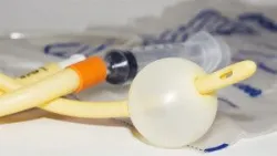 Phẫu thuật điều trị còn ổ nhớp lộ ngoài