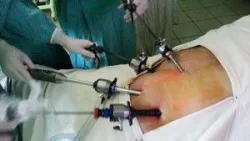 Biến chứng sau phẫu thuật nội soi cắt thận