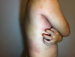 Biến chứng thận do bệnh lupus ban đỏ hệ thống