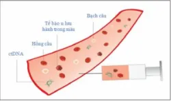 Tìm hiểu về phương pháp sinh thiết lỏng ctDNA chẩn đoán ung thư