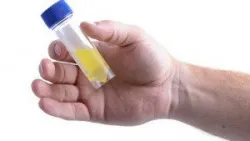Vì sao cần lấy nước tiểu giữa dòng để xét nghiệm?