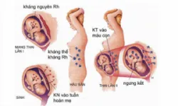 Nhóm máu hệ Rh (Rhesus)