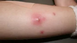 Các tai biến có thể xảy ra khi tiêm bắp