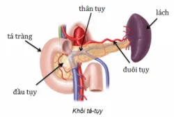 Mổ nội soi cắt thân và đuôi tụy