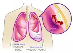 Cấp cứu tràn khí màng phổi
