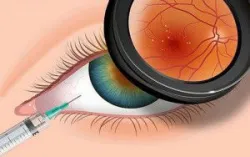 Điều trị thoái hóa điểm vàng liên quan đến tuổi tác (AMD)