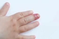 Biến chứng của chín mé nếu không điều trị kịp thời