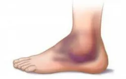 Phù chân khi đứng lâu, có phải mắc bệnh mạch máu?