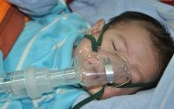 Gây mê nội khí quản phẫu thuật tháo lồng ruột