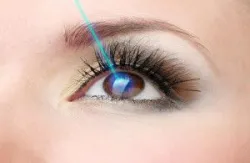 Nguyên nhân tái cận sau mổ LASIK và cách phòng tránh