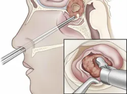 Quy trình phẫu thuật nội soi cắt bỏ u tuyến yên qua đường xương bướm