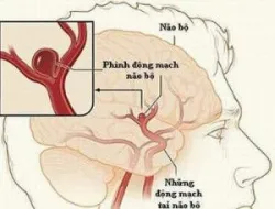 Chảy máu dưới nhện Phần 1: Khái niệm và nguyên nhân gây bệnh