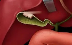 Nhiễm trùng đường mật