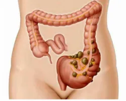 Phân độ bệnh viêm túi thừa đại tràng