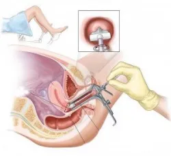 Xét nghiệm Pap sau mãn kinh