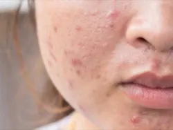 Cách lựa chọn kem dưỡng ẩm cho da dầu mụn