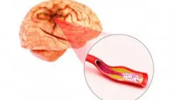 Can thiệp động mạch đốt sống: Những điều cần biết