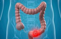 Mối liên quan giữa Polyp và ung thư đại trực tràng