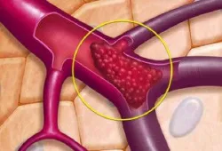 Chụp số hóa xóa nền và nút giãn tĩnh mạch buồng trứng