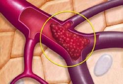 Chụp số hóa xóa nền và nút động mạch cầm máu các tạng