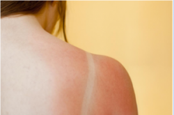 Ý nghĩa của xét nghiệm kháng thể kháng nhân trong chẩn đoán lupus ban đỏ