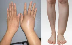 Hội chứng vùi lấp: Những điều cần biết
