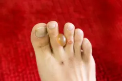 Mối liên hệ bệnh tiểu đường với bệnh của da