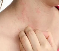 10 dấu hiệu không thể bỏ qua của da nhạy cảm