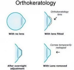 Bạn có thực sự hiểu rõ về Ortho – K?