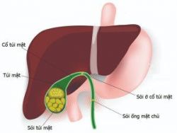 Giá trị của đặt stent đường mật trong điều trị tắc nghẽn ống mật