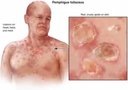 Bệnh Pemphigus: Nguyên nhân, triệu chứng và cách điều trị