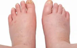 Bệnh thận do viêm thành mạch dị ứng (Phần 2)