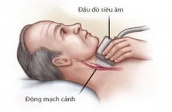 Quy trình thực hiện siêu âm hệ mạch cảnh