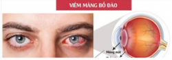 Tại sao bạn nên xử trí viêm màng bồ đào sớm?
