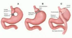 Giảm mỡ ở vòng eo của bạn