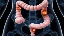 Các ứng dụng mới của trí tuệ nhân tạo trong lĩnh vực tiêu hóa