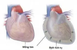 Phân biệt sốc tim, sốc giảm thể tích, sốc tắc nghẽn