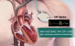 Hội chứng Brugada: Chẩn đoán và điều trị