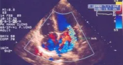 Siêu âm tim Doppler màu đánh giá hở van hai lá