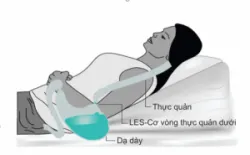 Nên ngủ và tập thể dục như thế nào khi bị viêm thanh quản trào ngược?