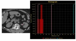 Chụp CT hai mức năng lượng: Xác định thành phần sỏi thận tiết niệu