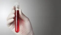 Vai trò của xét nghiệm calprotectin và dấu ấn sinh học trong chẩn đoán viêm loét đại tràng chảy máu